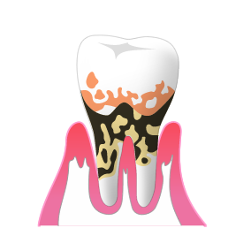 重度の歯周病には、レーザー治療を行います